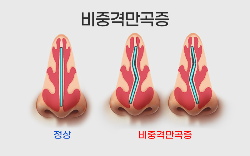 비중격-만곡증-치료로-되찾는-건강한-호흡-자가진단-방법