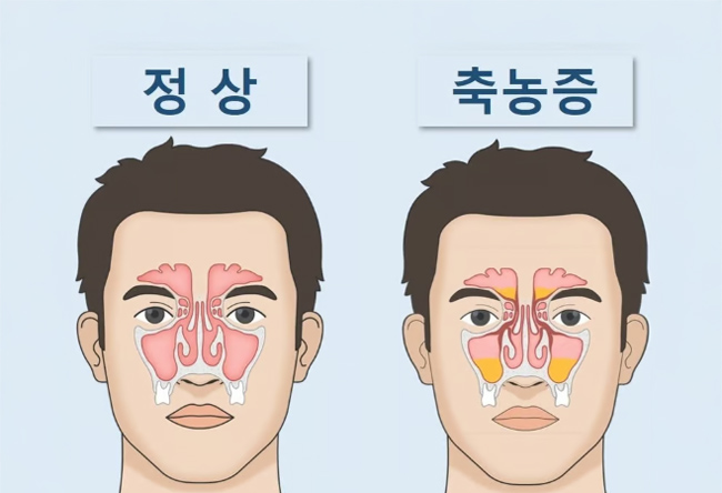 부비동염-축농증-정상비교